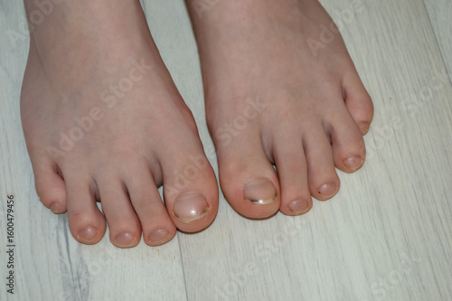 child's feet with uncut and dirty nails