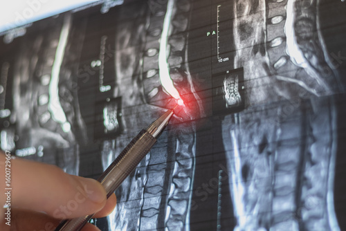 Doctor learning MRI of the lumbar spine.  At level 12, an arachnoid cyst measuring 13x14 mm is identified on the left.