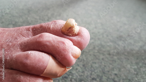 Foto thickened, tall big toenail of a senior citizen, requires foot care