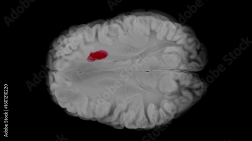 Axial animation of glioblastoma developing in the left frontal lobe. Tumor enlarges with tissue compression and progressive midline shift. Transparent background.