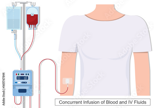Concurrent infusions are the simultaneous infusion of multiple drugs.
