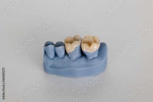 Photos Close-up of blue dental cast showing tooth inlays and onlays