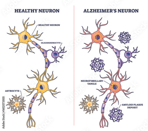 Alzheimers neuron diagram shows comparison of healthy and diseased neurons, highlighting amyloid plaques and neurofibrillary tangles. Outline diagram