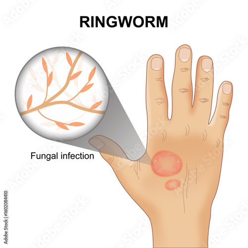 Ringworm fungal infection illustration on hand