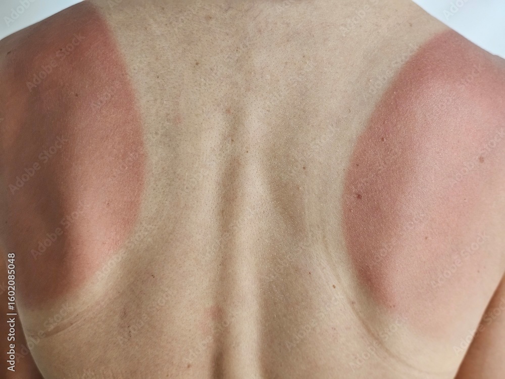 Fototapeta premium Sunburnt back showing red patches after a day outdoors, showcasing skin