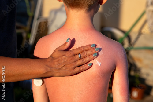 Принти на полотні Applying soothing lotion to sunburned child with glucose monitor on the arm