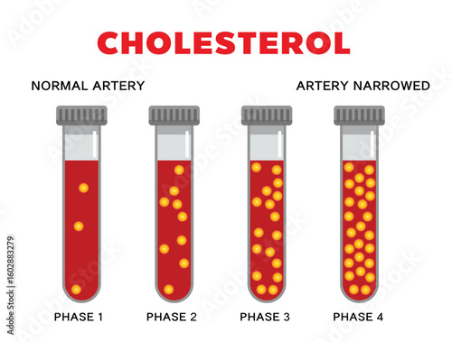 Cholesterol in artery, health risk , vector design