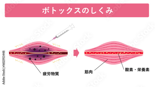 ボトックスのしくみ