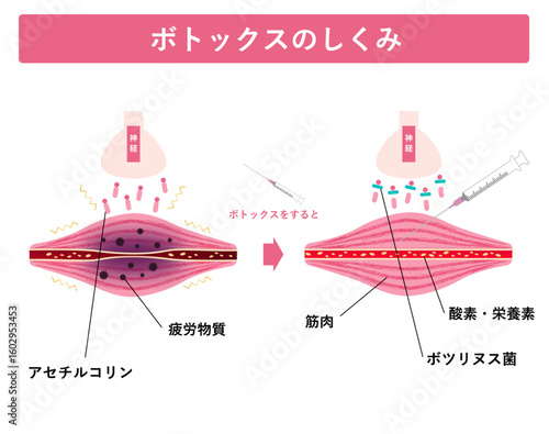 ボトックス注射のしくみ