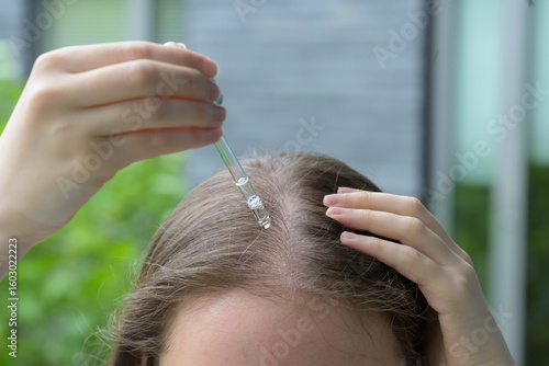 Close up of a woman applying serum to dry irritated and itchy scalp with a glass dropper. Concept of skincare, scalp treatment, hydration, self care and hair health with focus on roots and moisture.