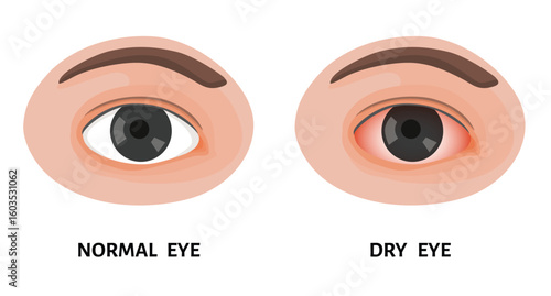 Normal eye and dry eye, irritated eye, redness, conjunctivitis