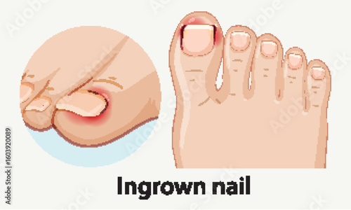 Vector Illustration of Ingrown Toenail on Human Foot