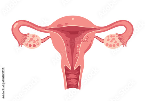 A diagram of a uterus with ovaries and fallopian tubes shown on a white background