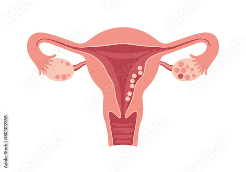 Anatomical illustration of a female reproductive system showcasing the uterus ovaries fallopian tubes and eggs