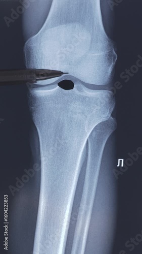 Vertical video, doctor examining X-ray scan of knee joint. 