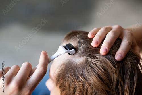Tableau sur toile Man using derma roller on scalp for hair growth treatment, close-up of hands applying microneedling device to head