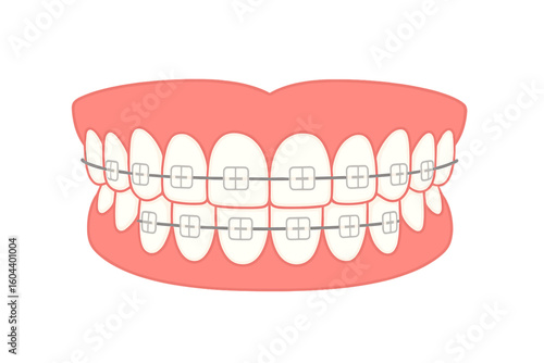 Human teeth with metal braces vector illustration. Orthodontic dental treatment concept. Mouth with brackets for smile correction and alignment. Healthy white teeth and gums.