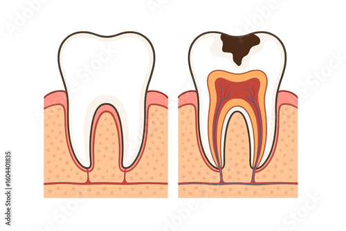 Tooth decay vector illustration. Healthy tooth versus tooth with caries disease. Dental anatomy cross-section showing enamel, dentin, pulp damage. Dental care, health concept.