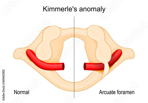 Arcuate foramen. Ponticulus posticus. Little posterior bridge. Kimmerles anomaly. Atlas structure.