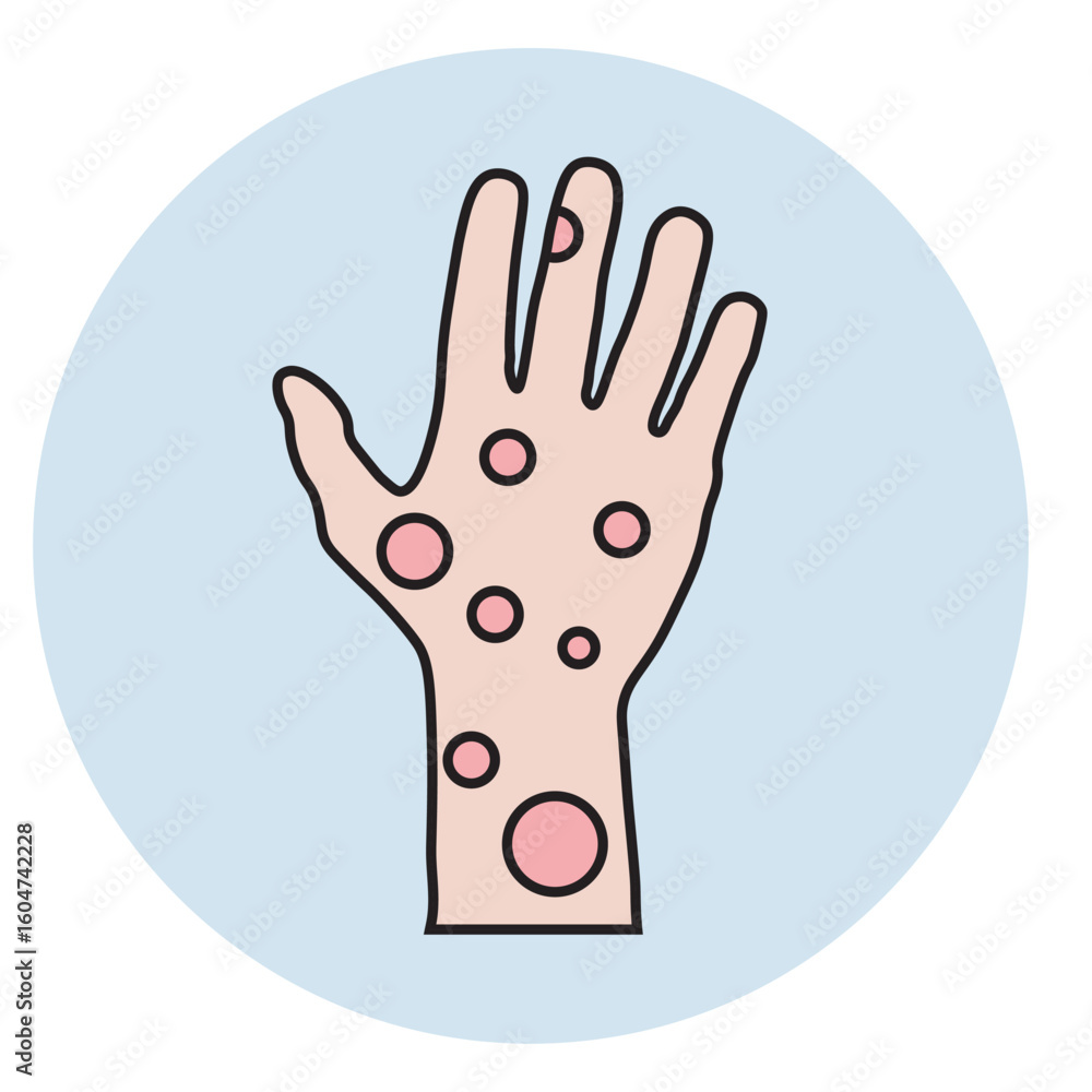 Obraz premium hand icon Atopic eczema vector illustration showing itchy, red, scaly skin; includes symptoms like dryness and swelling. Highlights similar diseases: psoriasis, contact dermatitis.