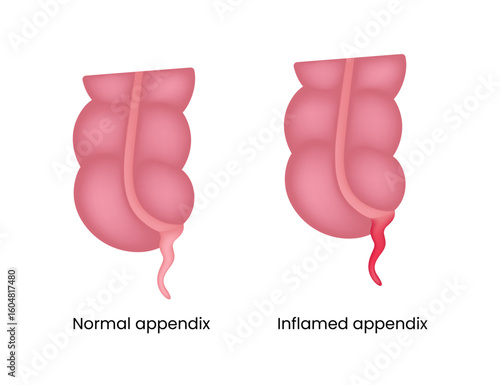 Normal and Inflamed Appendix Illustration