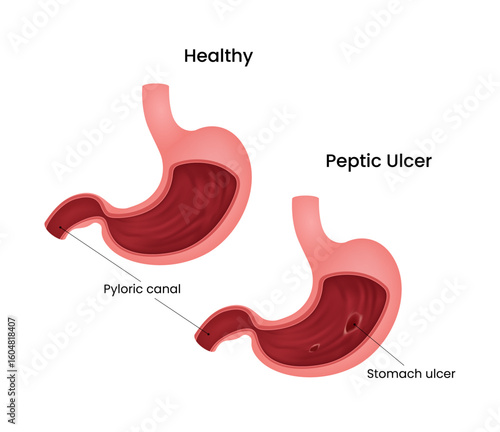 Healthy Stomach vs Peptic Ulcer Anatomical Comparison