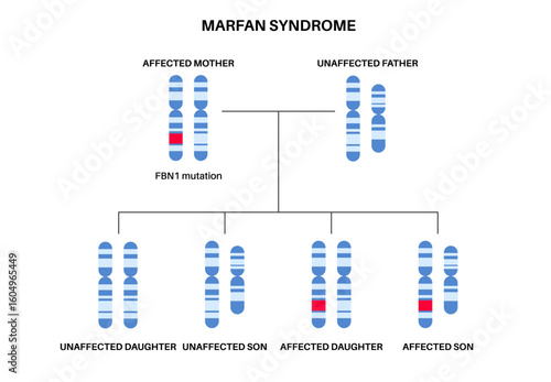 Marfan syndrome poster