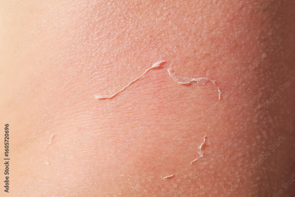 Fototapeta premium Woman with peeling skin from sunburn, closeup