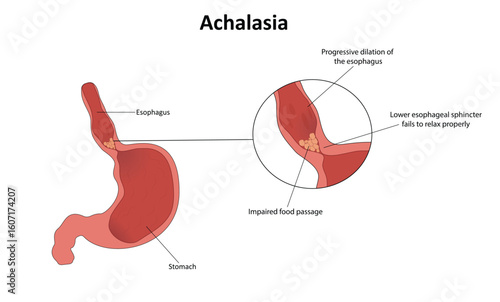 Achalasia vector illustration