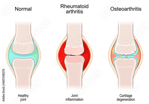 Comparative Joint Pathology. Healthy joint,  Rheumatoid arthritis, Osteoarthritis