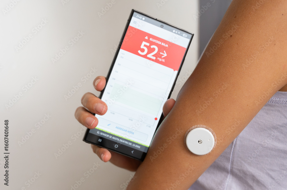 Ταπετσαρία Patient with hypoglycemia monitoring glucose levels with continuous glucose moni