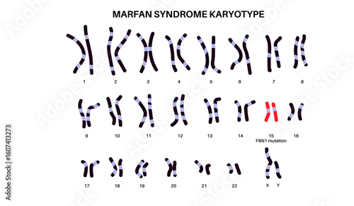 Marfan syndrome poster