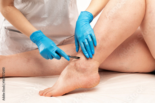 Foto doctor shows  the dilation of small blood vessels of the skin on the leg