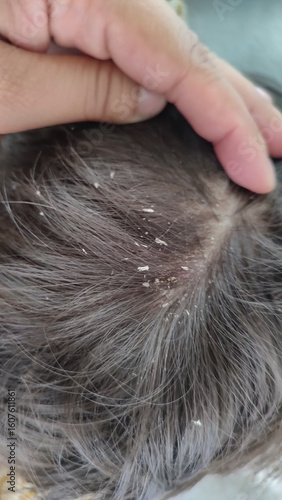 Close-up of a child's head, covered in dandruff and with red hair.