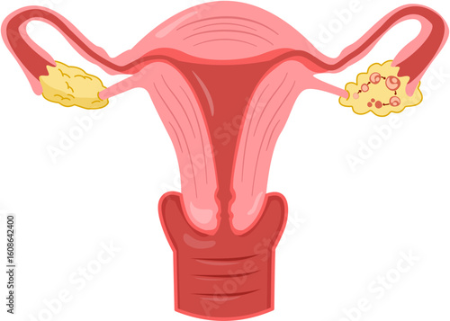 Polycystic ovary