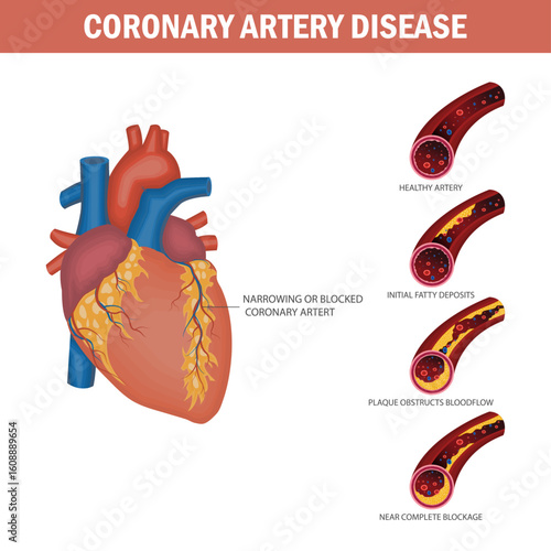 Medical illustration of coronary artery disease progression showing plaque buildup and heart artery blockage stages. Stages of Coronary Artery Disease in Human Heart.

