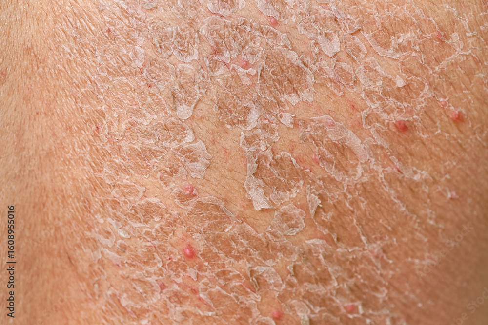 Fototapeta premium Dangerous sunburn. The shoulders and spine of caucasian man. Men with sun damaged peeling skin on the back. Peeling skin from a sunburn. Skin and Body Care. Sun protection.