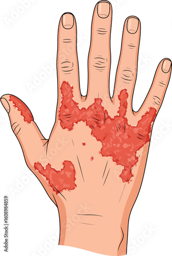 Illustration of a hand with red, inflamed skin patches, indicating a skin condition or rash.