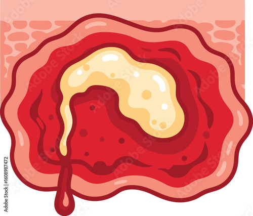 A stylized illustration of a wound with yellowish pus and blood.