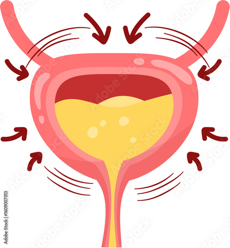 Overactive bladder
