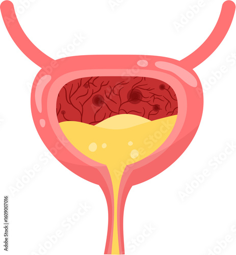 Cystic Bladder