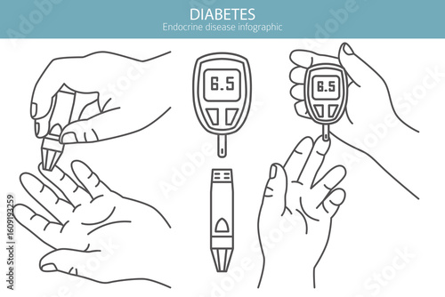 Diabetes. Endocrine diseases. Medical infographic design. Vector illustration