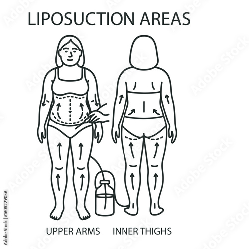 Liposuction Areas Procedure Illustration