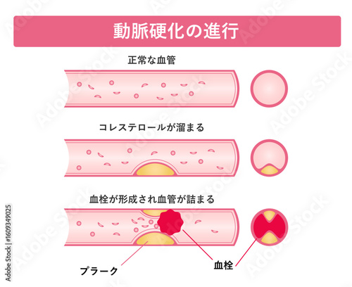 動脈硬化の進行