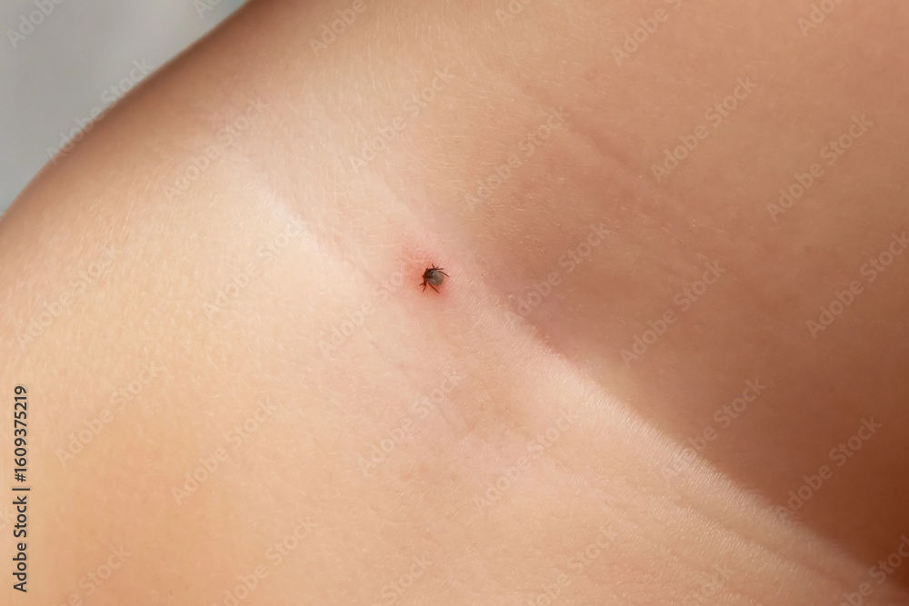 Fototapeta premium Mite dug into the skin of a small child, the danger of the summer in the woods