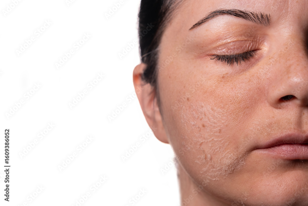 Fototapeta premium Woman peeling facial skin – Skincare treatment concept – Female face with flaky skin after exfoliation