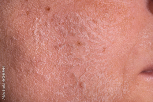 Skin shedding and regeneration close-up – Dermatology concept – Peeling human skin