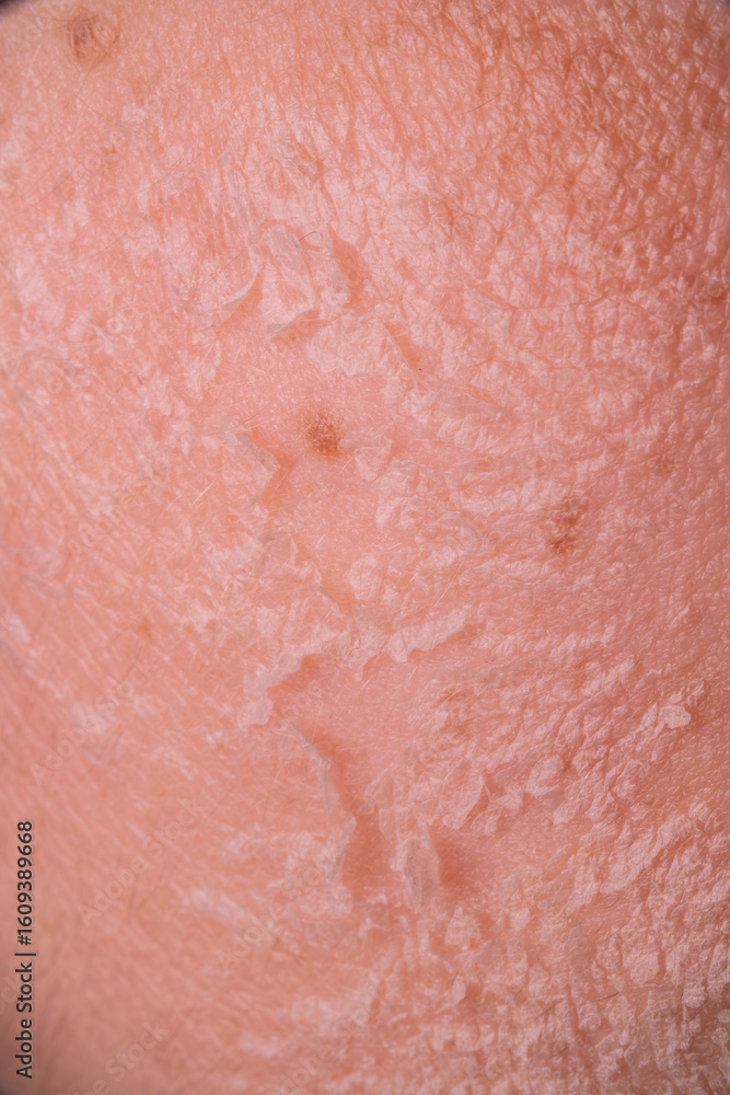 Fototapeta premium Skin shedding and regeneration close-up – Dermatology concept – Peeling human skin
