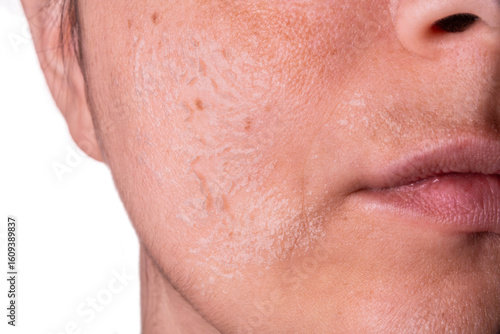 Woman peeling facial skin – Skincare treatment concept – Female face with flaky skin after exfoliation