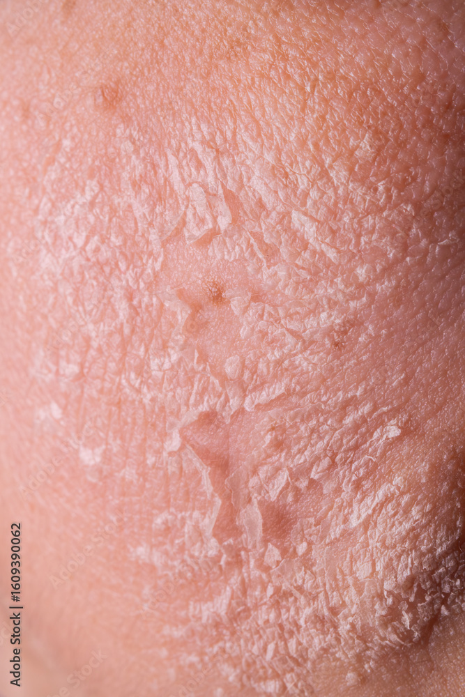 Fototapeta premium Skin shedding and regeneration close-up – Dermatology concept – Peeling human skin